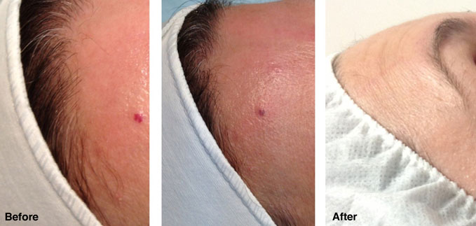 before-after-redness-reduction5