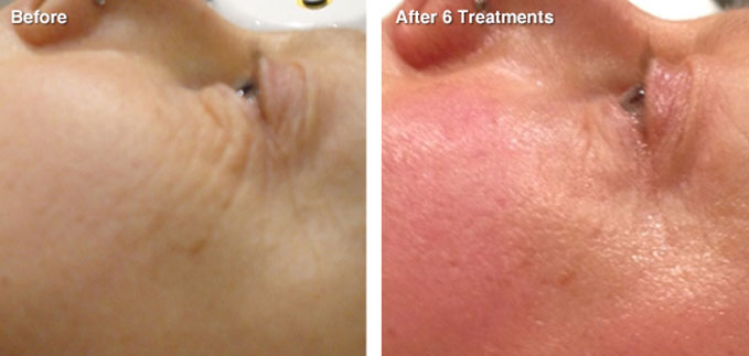 before-after-skin-tightening1
